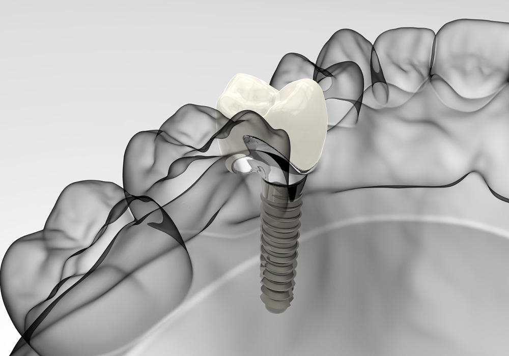 dental implants north sydney