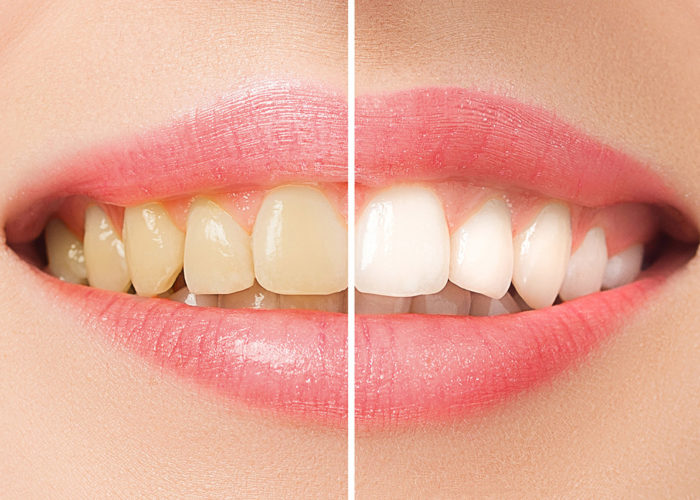 before and after teeth whitening